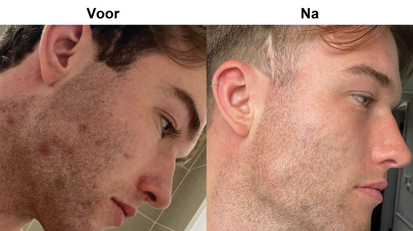 Voor en na - George