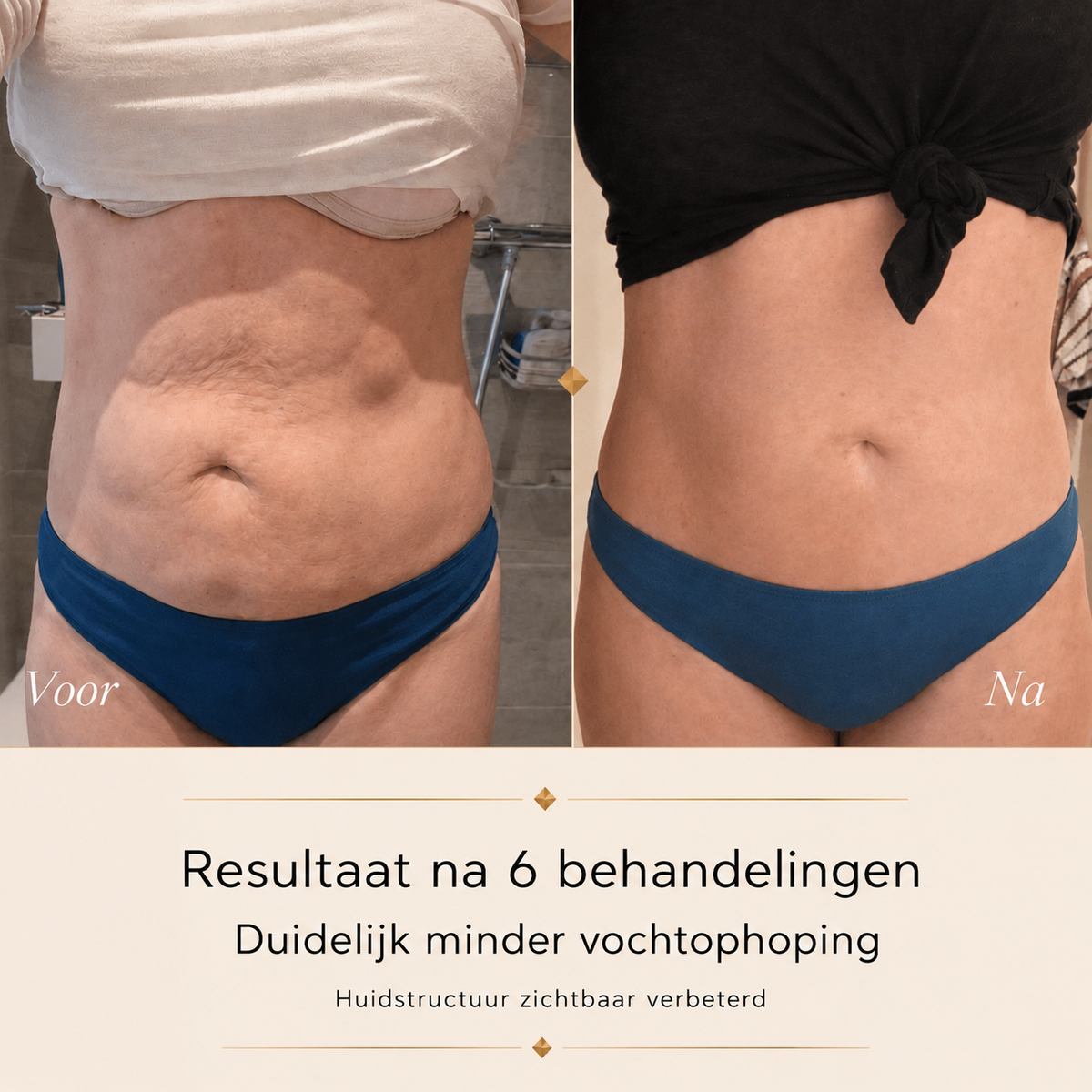 Celluxe™ - Anti-cellulite
